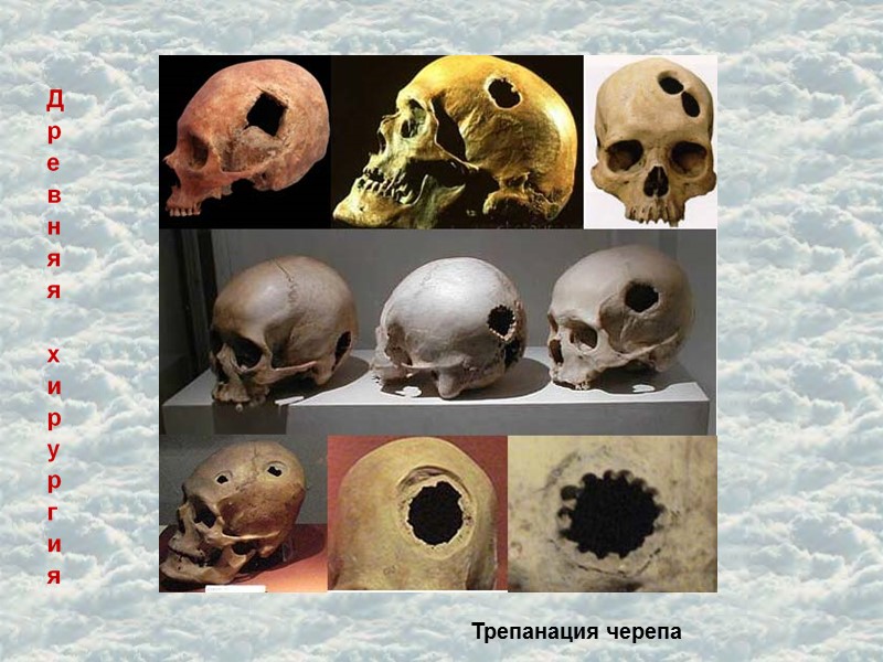 Трепанация черепа